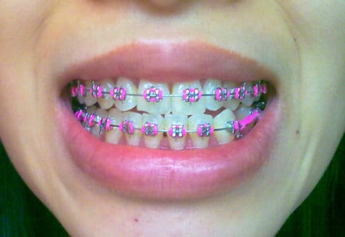 Braces