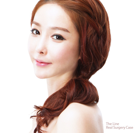 Facial Contouring in Korea within affordable cost